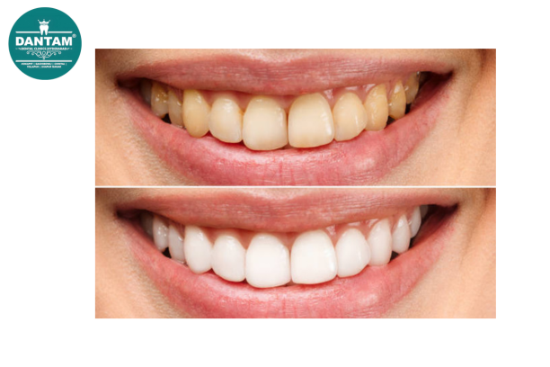 Best Dental Clinic in Kondapur -Dantam Dental