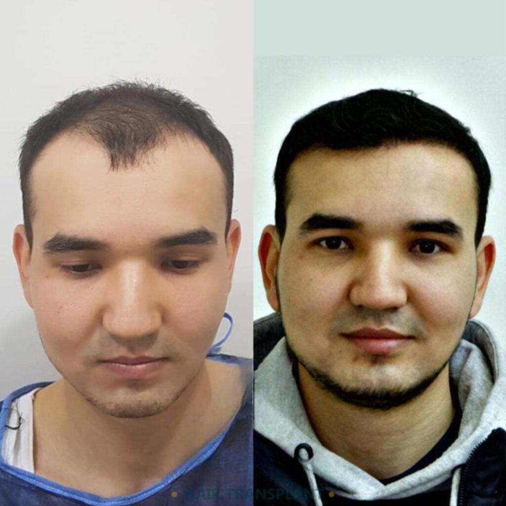 FUT Hair Transplant in Islamabad